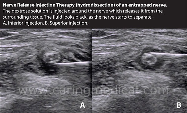 tibial n. 아래쪽으로 약침을 주사해 신경을 주변조직과 박리하고 다음으로 위쪽으로 약침을 주사해서 신경주변 박리