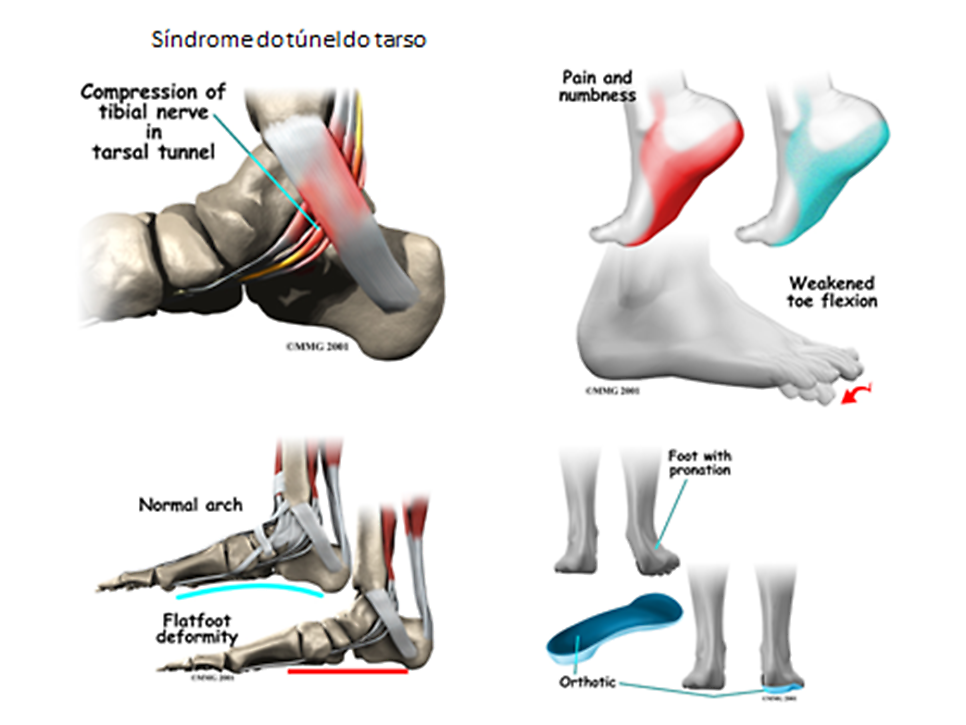 tarsal tunnel syndrome의 증상부위 및 발생원인(족저아치가 무너지고 발의 회내)