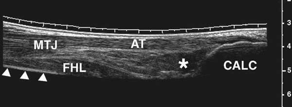 https://www.ultrasound-guided-injections.co.uk/insertional-achilles-tendinopathy-and-the-role-of-a-diagnostic-ultrasound-scan/