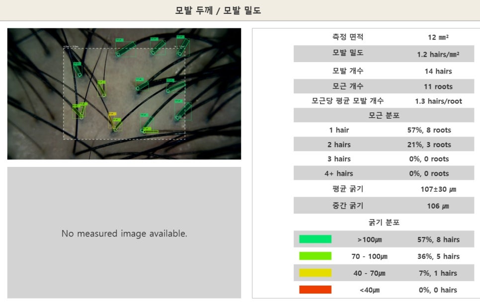 자동 분석을 통해 모발의 밀도, 개수, 굵기 등을 확인할 수 있습니다.