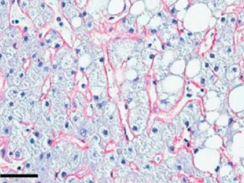 섬유화된 부분을 파랗게 염색해주는 masson's trichrome 염색법
