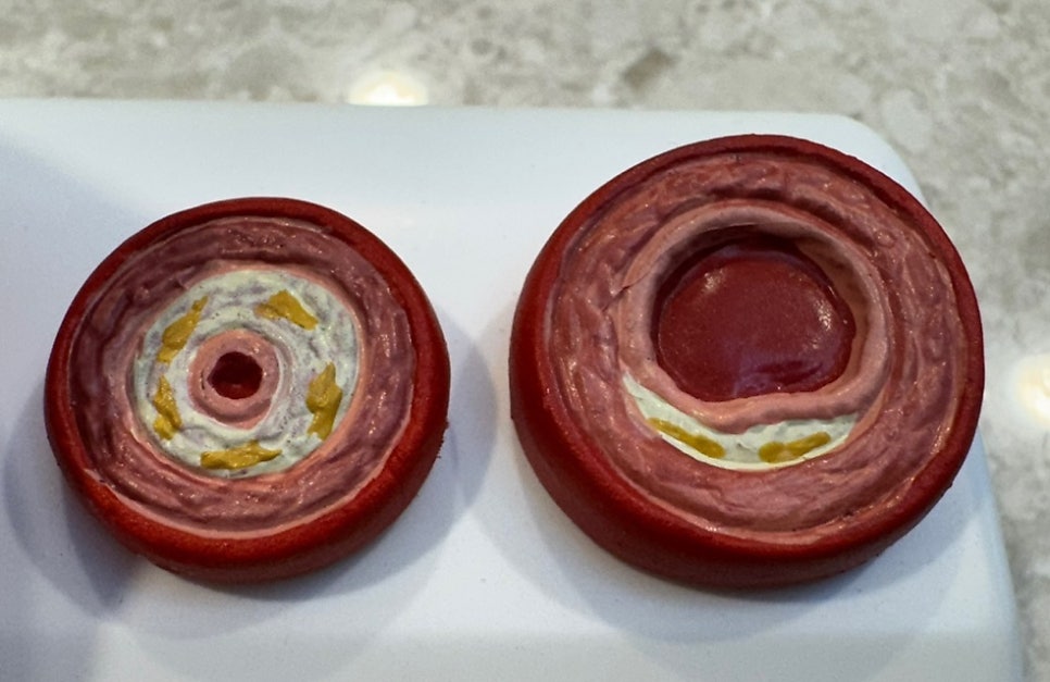 동맥경화가 일어난 혈관의 단면입니다. LDL이 하는 일입니다.