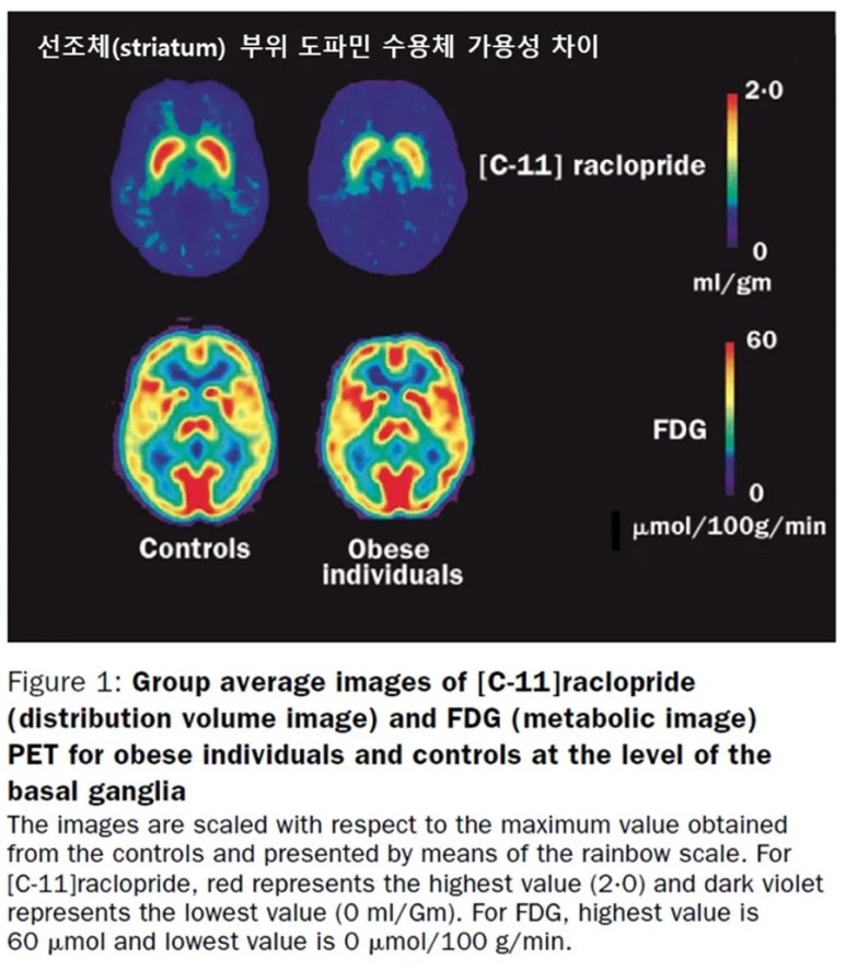 WANG, Gene-Jack, et al. Brain dopamine and obesity. The Lancet, 2001, 357.9253: 354-357.