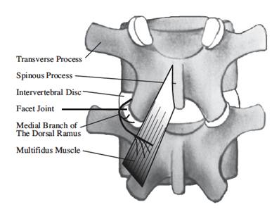 다열근(multifidus)을 지배하는 내측지(medial branch)