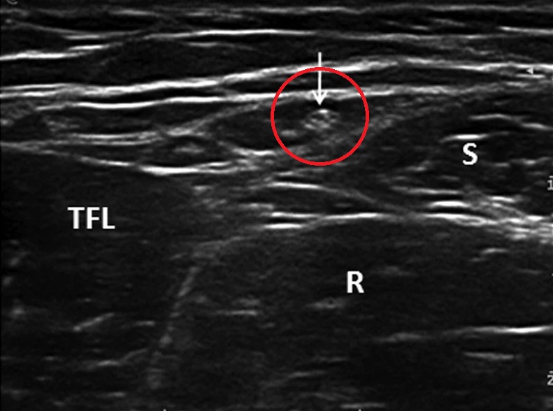 초음파 상 관찰되는 대퇴외측피신경(빨간 동그라미)Zhu, J. et al. Ultrasound of the lateral femoral cutaneous nerve in asymptomatic adults. BMC Musculoskelet Disord 13, 227 (2012).