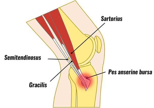 반건양근(semitendinosus), 봉공근(sartorius), 박근(gracilis)이 모여서 만들어진 거위발건(pes anserinus)