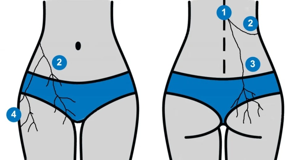 흉요추 접합부 증후군의 통증 부위https://www.trifectatherapeutics.com/