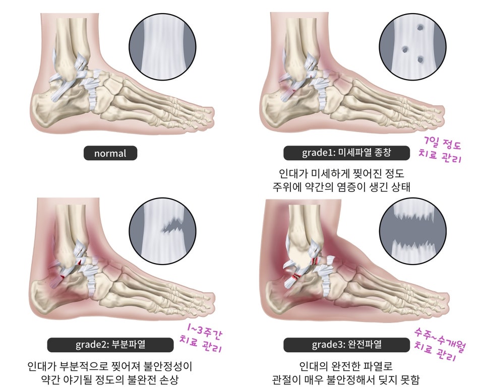 발목염좌 Grade