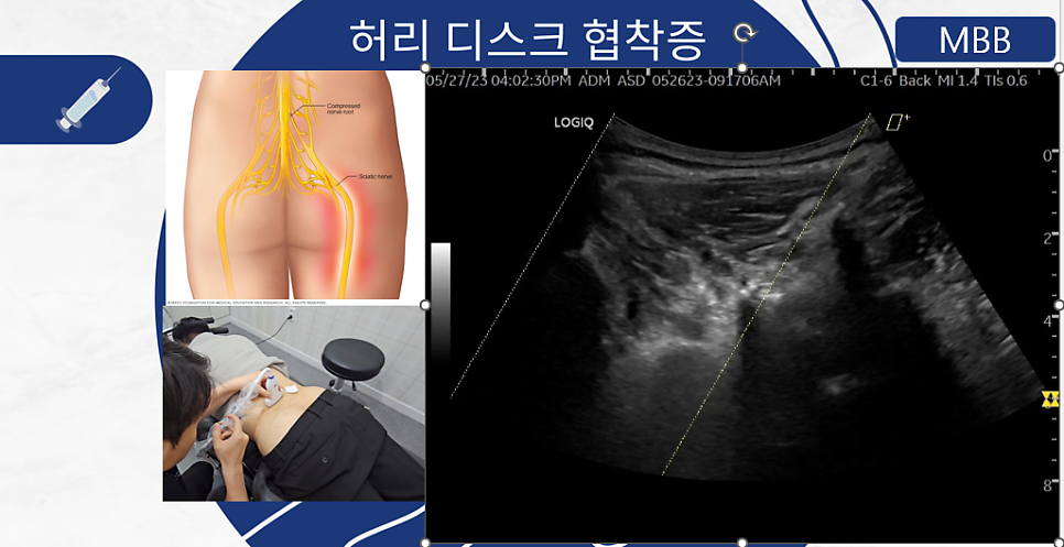 초음파 가이딩 약침 - 허리디스크, 협착증
