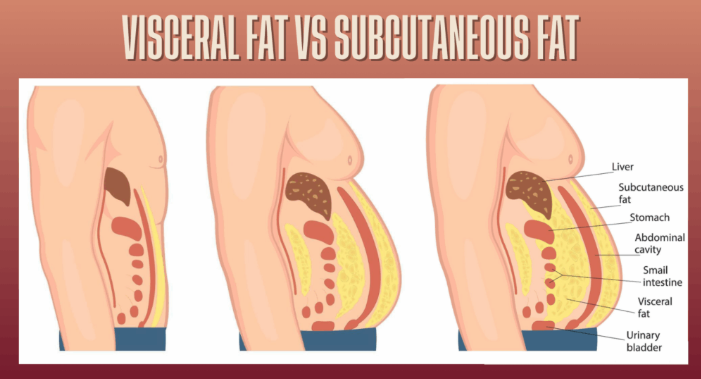 내장지방(visceral fat)과 피하지방(subcutaenous fat)