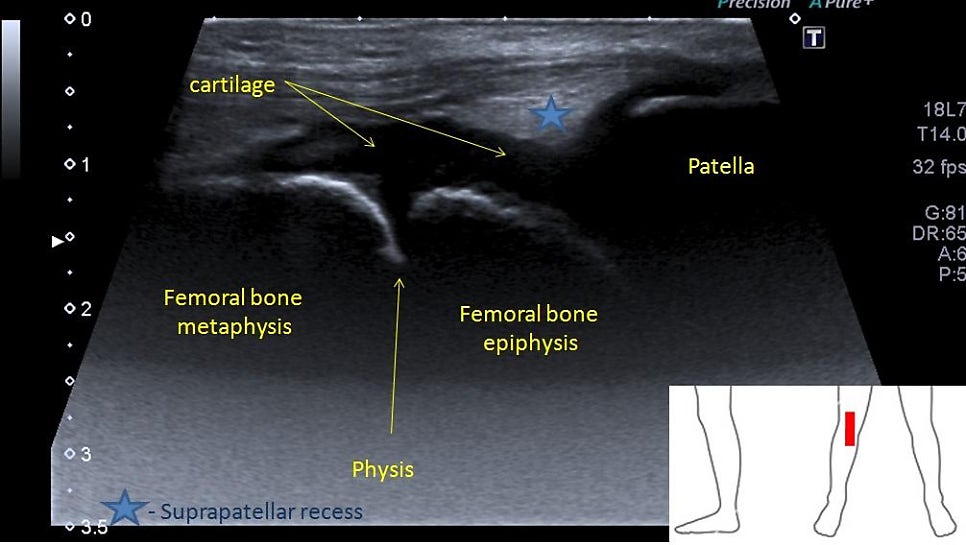 출처: Pediatric musculoskeletal ultrasound literature