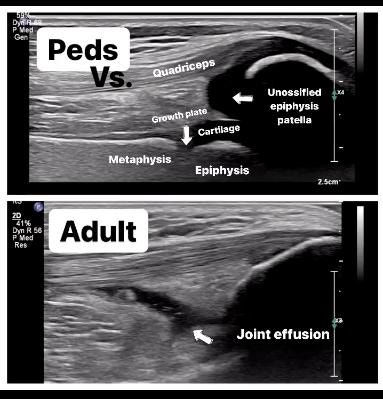 출처: Pediatric musculoskeletal ultrasound educational materials