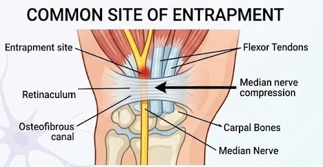 Retinaculum 앞뒤로 입구(손목쪽)와 출구(손끝쪽)