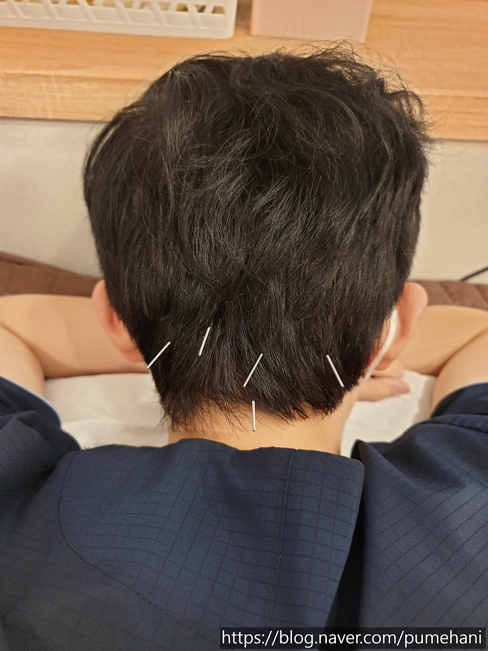 침 시술 모습. 출처 : 나다.