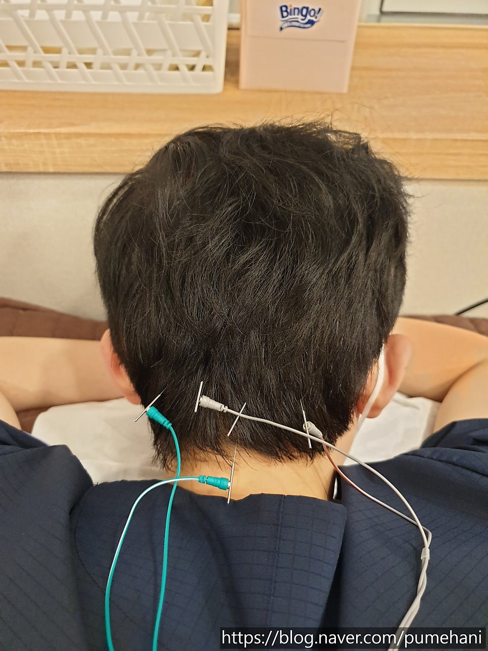 침치료 부위에 전기 자극을 한 모습. 출처 : 원장 본인