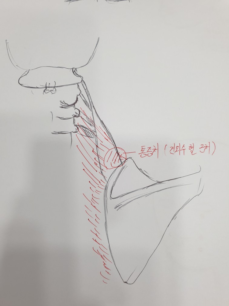빨간 빗금이 통증을 주로 호소하는 부위입니다.