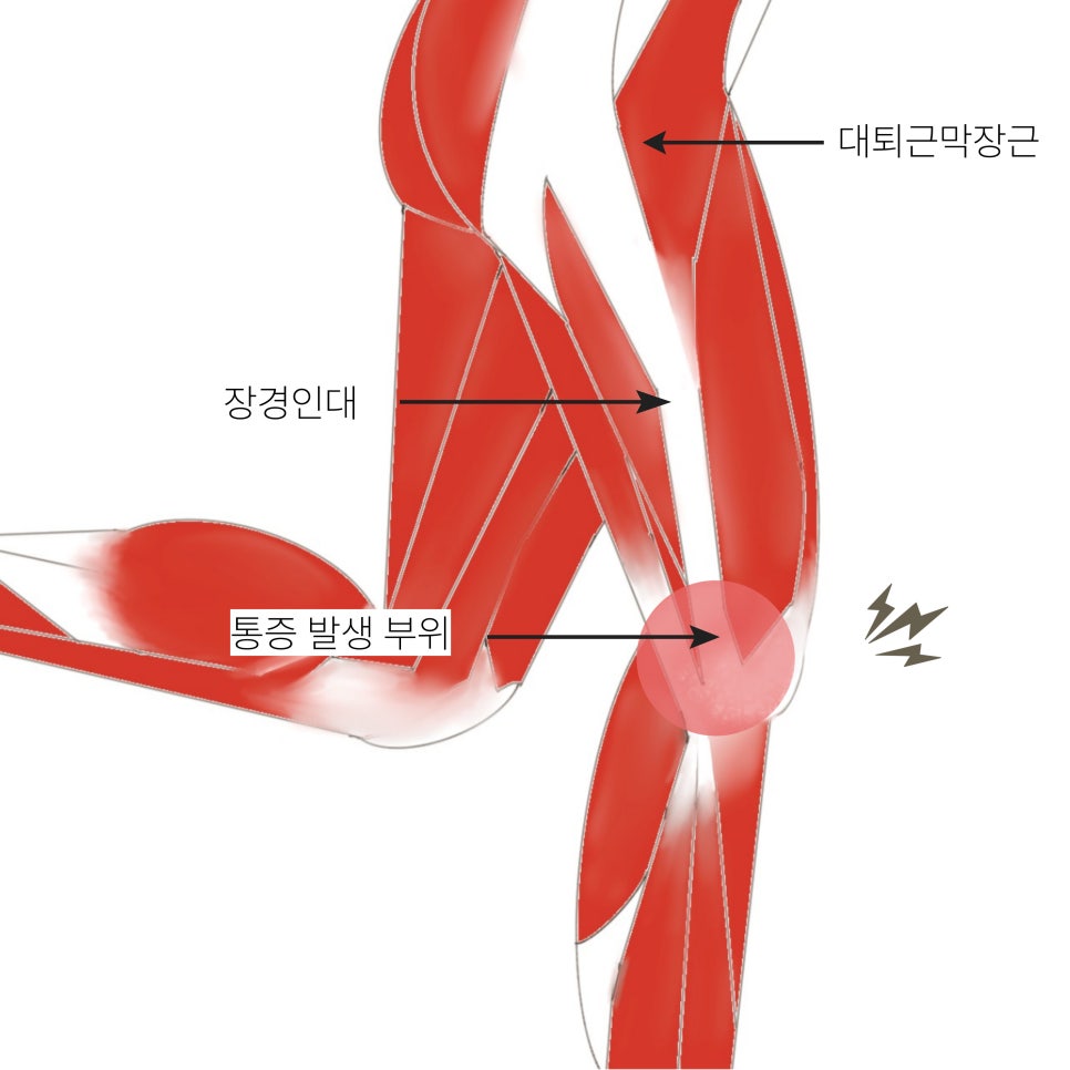 장경인대 증후군은 대퇴골 외측상과에서 느껴지는 통증이 특징입니다.