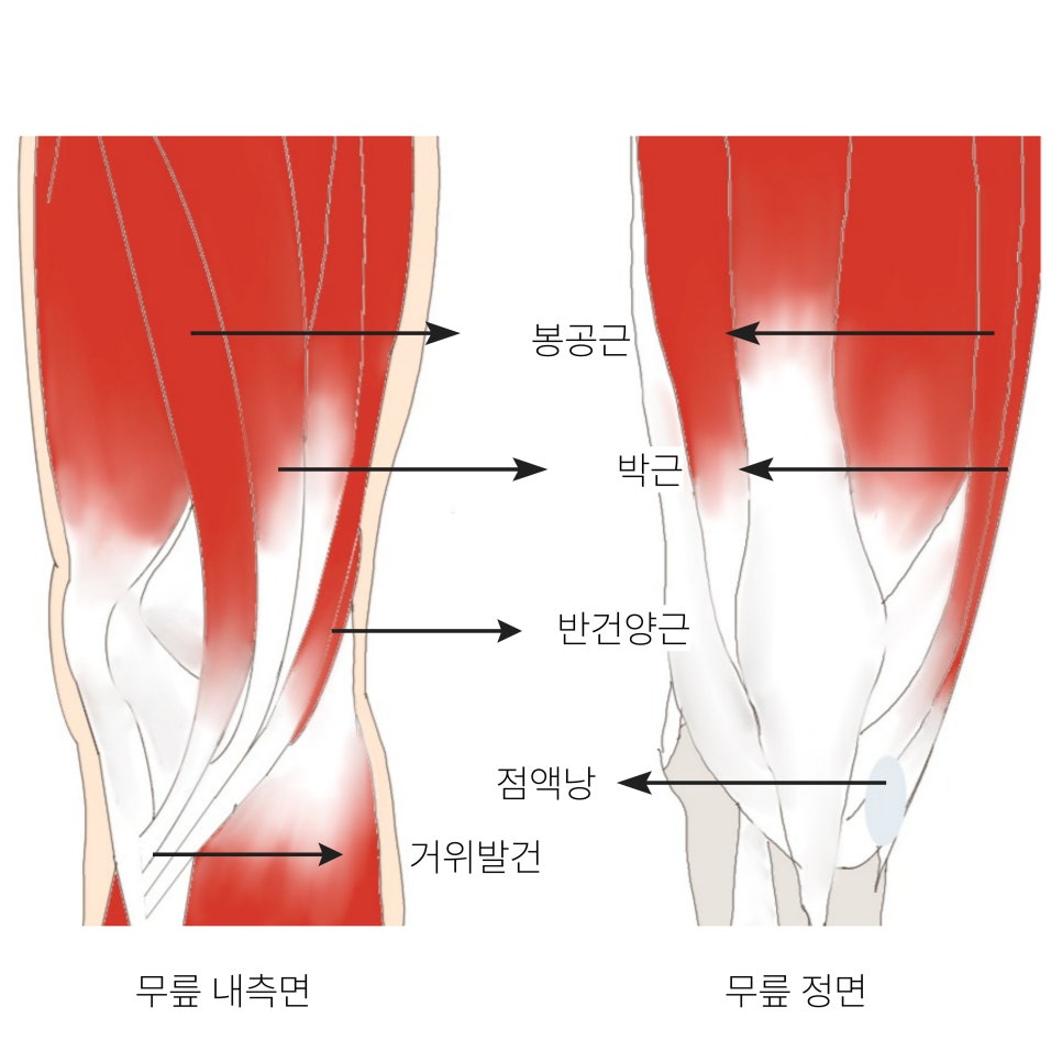 거위발건염은 복합적인 근육의 문제로 인해 발생합니다.