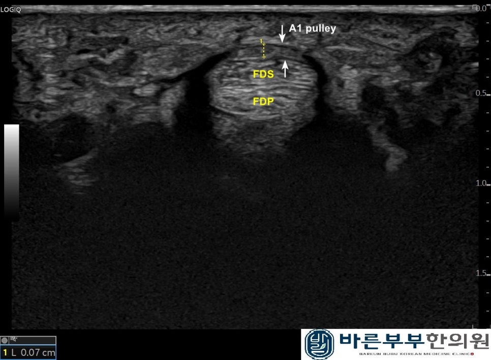 FDS : 천지굴근/ FDP : 심지굴근/ A1 pulley : A1 활차