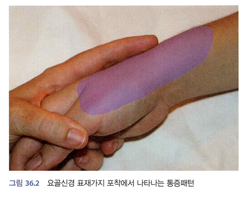 출처 : 말초신경포착증후군 임상증상과 치료