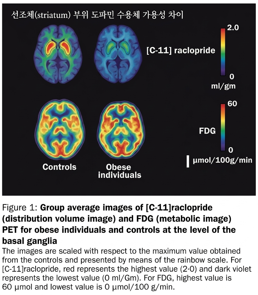WANG, Gene-Jack, et al. Brain dopamine and obesity. The Lancet, 2001, 357.9253: 354-357. 이미지 ai 변환