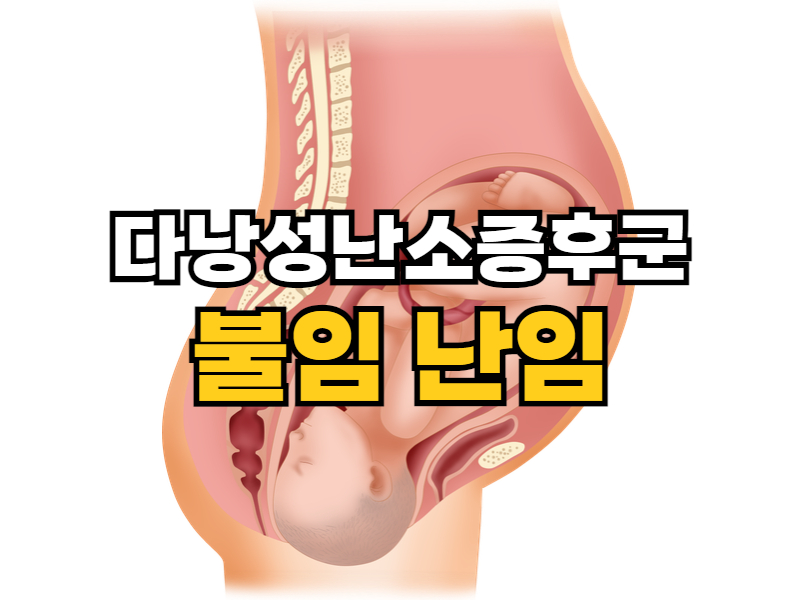 다낭성 난소증후군 증상 3: 불임 난임