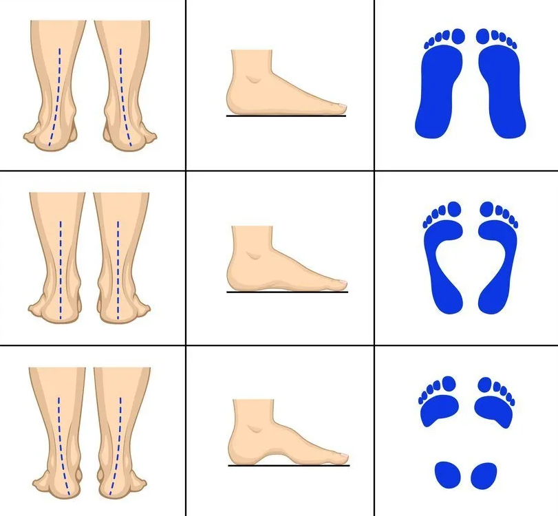 위에서부터 평발 / 정상 / 요족