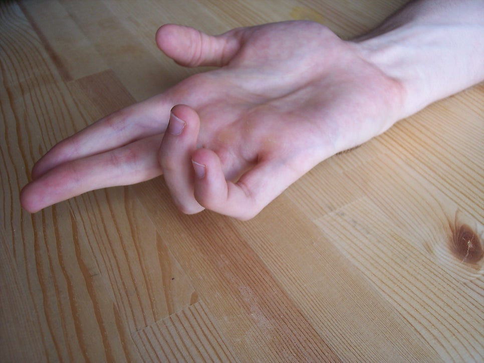 claw hand - 약지 소지의 구축