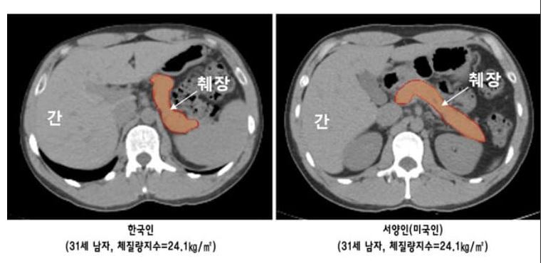 상대적으로 작은 동양인의 췌장크기