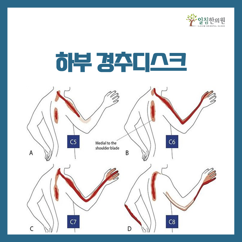 각각의 경추신경이 눌릴때 증상이 나타날 수 있는 부위입니다. 다만 증상은 꼭 그림과 동일하게 나타나는 것은 아니며, 일부분만 나타나는 경우도 많습니다. 따라서 목디스크 뿐만이 아니라 목~손끝까지 이어지는 신경을 중간에 다른 부분에서 자극을 받을때에도 비슷한 증상이 나타날 수 있습니다.