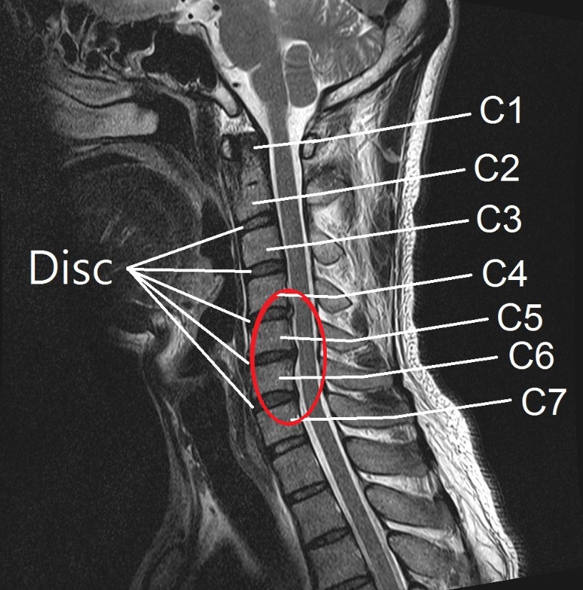동그라미 친 부분을 보시면 경추 4~5번, 5~6번 > 6~7번의 디스크가 탈출되어 신경이 눌리고 있는 모습을 볼 수 있습니다.
