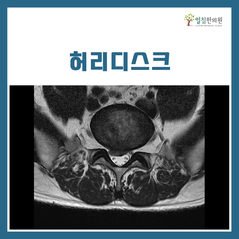 위의 두 사진 모두 환자분의 사진이며, 본원의 치료 후 밀려나온 디스크가 모두 회복되었음을 확인했던 분입니다.