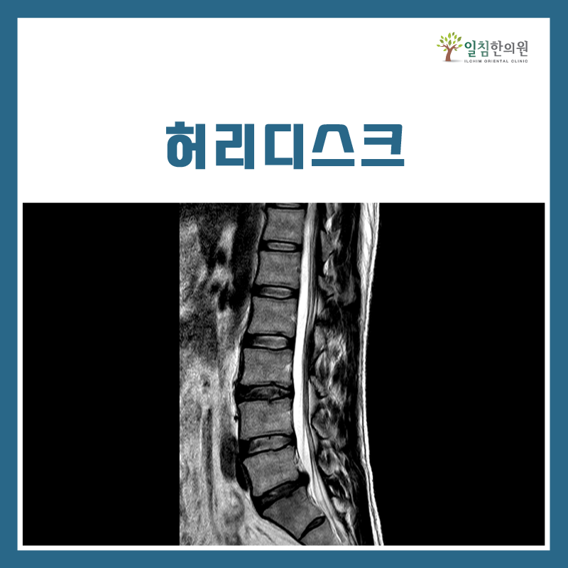허리는 5개의 뼈로 구성되어 있으며, 디스크는 이처럼 MRI 사진으로 확인하셔야 합니다. 엑스레이 검사 후 디스크라는 진단을 받으신 분들은 '디스크 일수도 있으니 확인이 필요합니다'로 이해하시는 것이 좋습니다.
