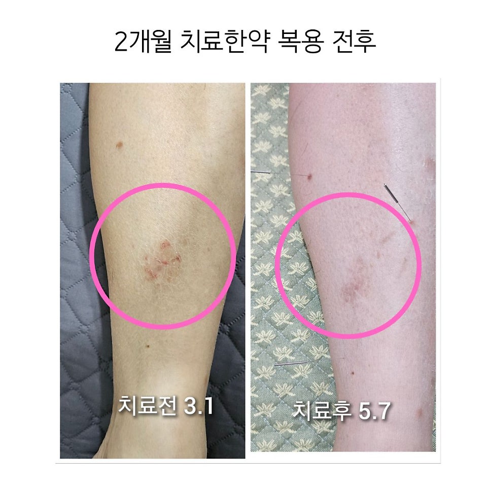 붉은 염증이 옅은 갈색빛으로 변화하여여 염증이 다 꺼진 양상을 볼수있습니다.