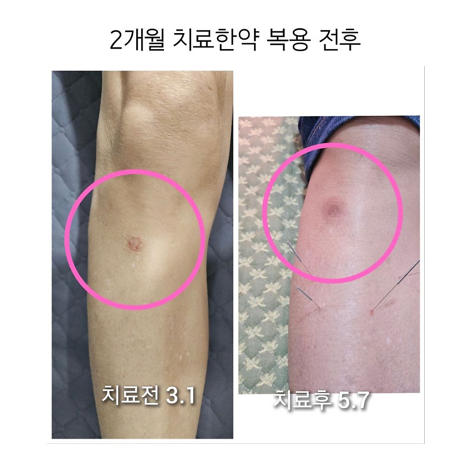 붉은 염증이 옅은 갈색빛으로 변화하여 염증이 다 꺼진 양상을 볼수있습니다.