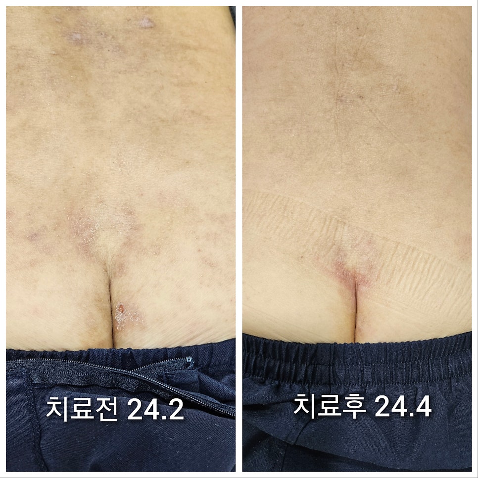 엉덩이쪽 고질적으로 앓고계시던 피부병변이 많이 아문 모습입니다~!