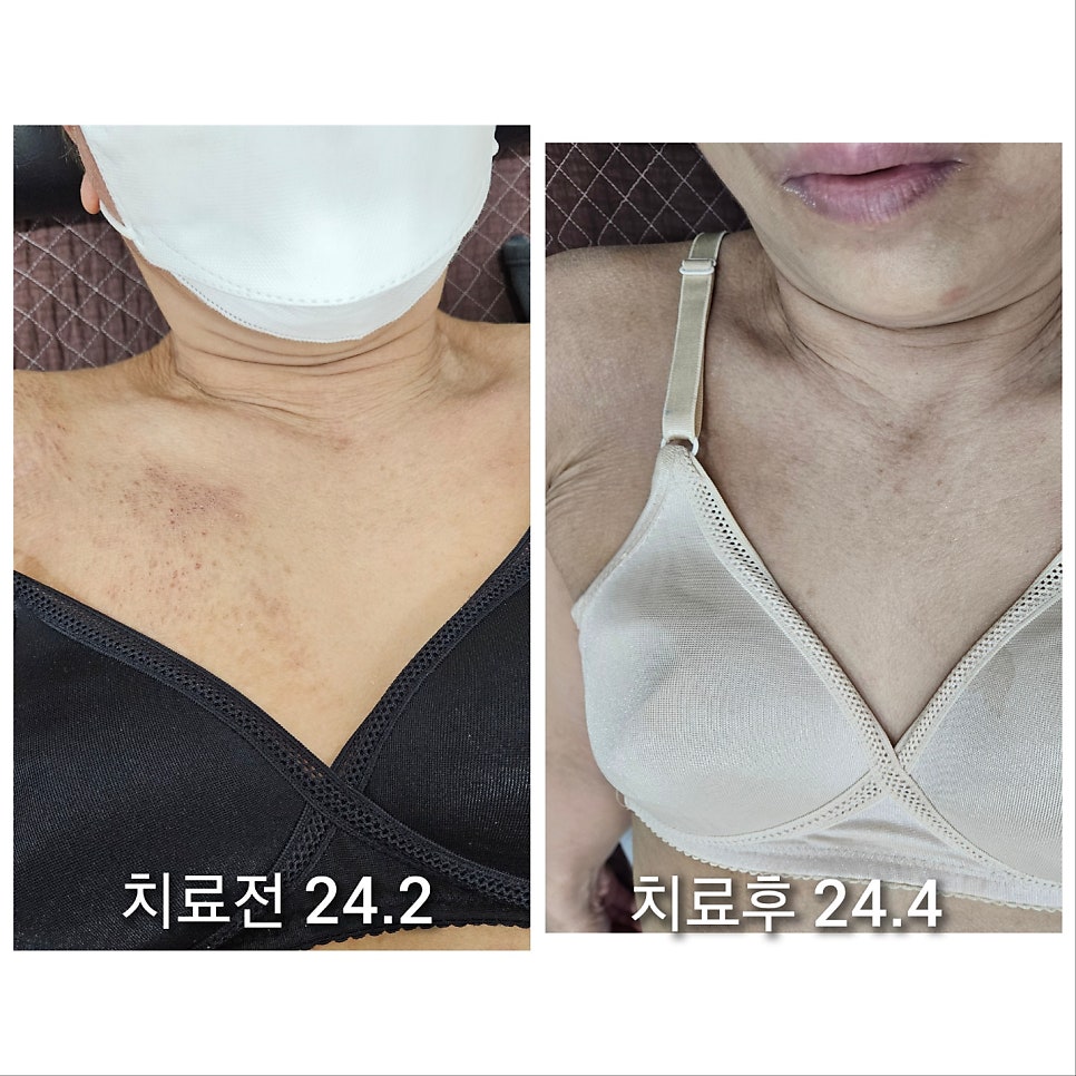 긁어서 검붉게 착색됬던 피부에서 새살이 다 차오른 모습입니다!