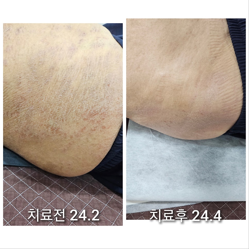 건조했던 피부가 윤기가 나고있죠!