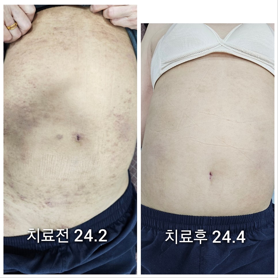 배쪽에 긁어서 생겼던 상처들이 많이 회복된 모습입니다. 현재는 다 새살이 돋았고 예전피부병변을 찾아볼수가 없네요! ㅎㅎ