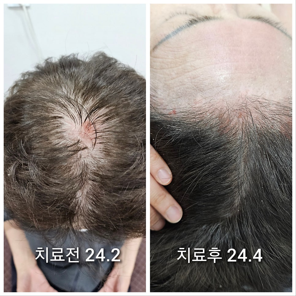 두피의 빨갛던 염증들이 많이 가라앉은 모습입니다. 이부분은 조금더 치료가 필요할것으로 보입니다.