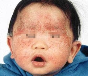 같은 아이의 얼굴이나 환부의 느낌이 많이 다릅니다.
