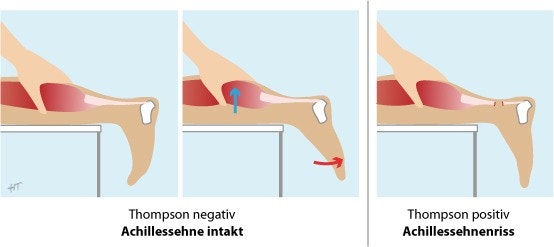 Thompson Test