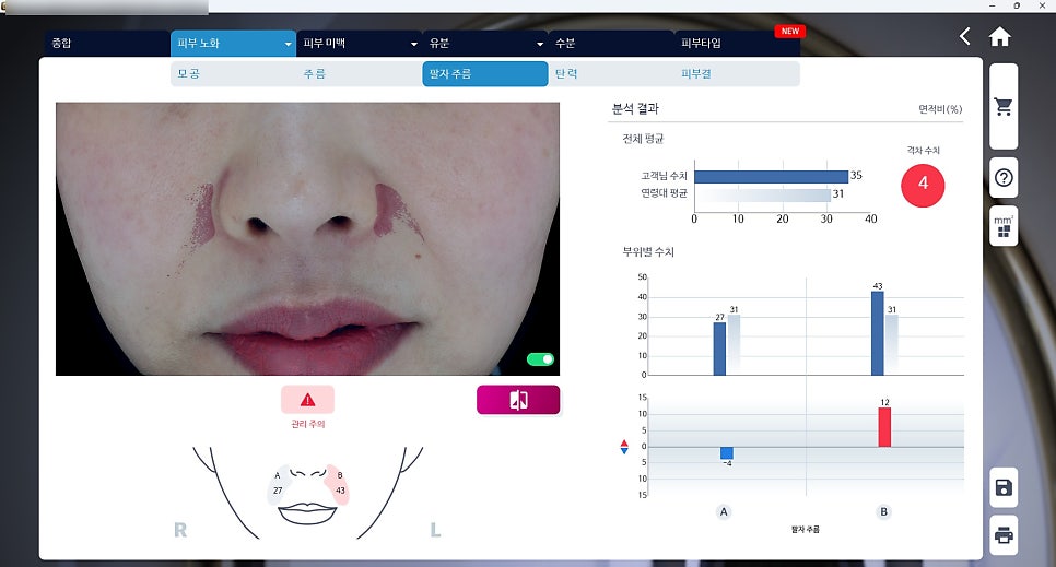 매선 치료 전, 장비를 이용해 주름의 깊어 범위 등등 꼼꼼하게 확인합니다^^