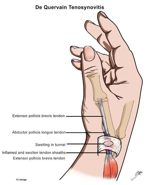 출처: https://step2.medbullets.com/orthopedics/120546/de-quervain-tenosynovitis