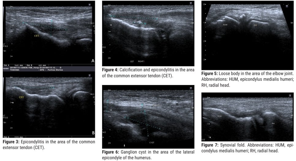 Konarski, W.; Pobo˙ zy, T. A clinical overview of the natural course and management of lateral epicondylitis. Orthopedics 2023, 46, e210–e218. 논문내에서인용. Figure3.에코 발생도 감소, 비후(두꺼워짐), 전형적인 섬유상 에코 구조의 소실을 동반한 국소 부위 Figure4. 힘줄의 석회화 / Figure5. 유리체 형성/Figure6. 결절종/Figure7. 활막 주름