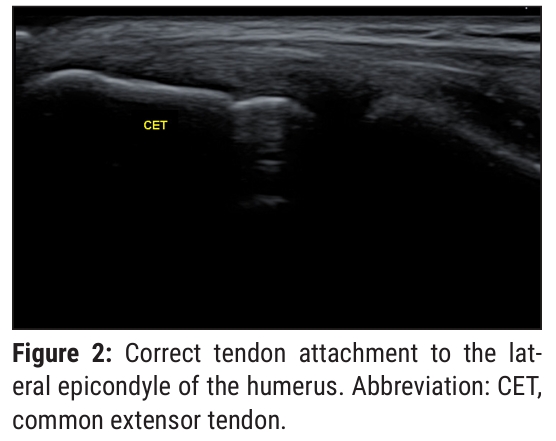 Konarski, W.; Pobo˙ zy, T. A clinical overview of the natural course and management of lateral epicondylitis. Orthopedics 2023, 46, e210–e218 논문내에서 인용. 공통신전건 초음파 사진.