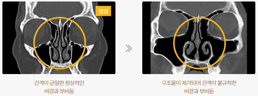 축농증 수술 이후의 코 (기존의 축농증 수술)