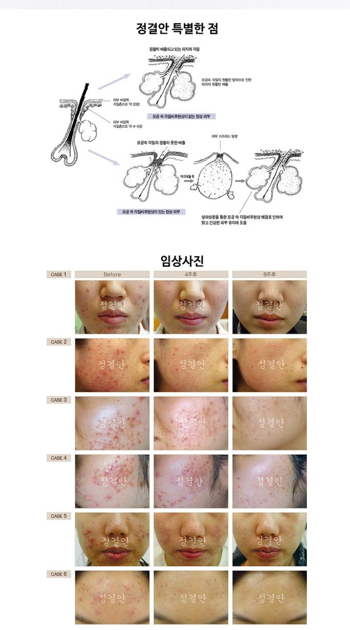안양여드름한의원 경희희망입니다. 여드름 홈케어, 정결안 설파젤 사용법