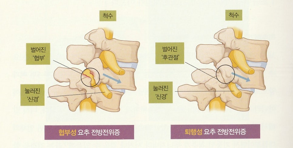 사진출처_척추힐링(척추힐링협회)_요추 전방전위증