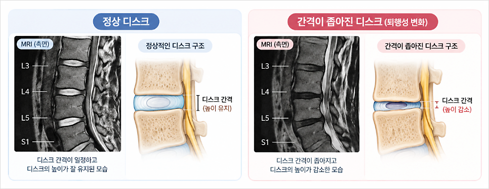정상 디스크 VS 퇴행성 디스크